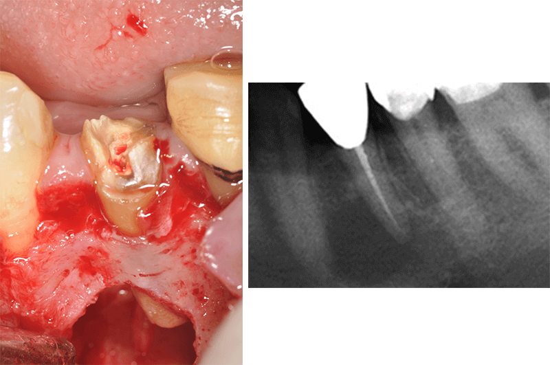 精密歯科治療の症例1 治療前